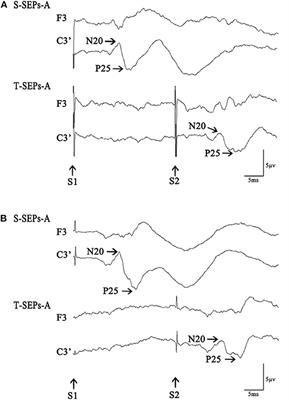 The Suppressive Effect of the Motor System on the Sensory System in Patients With Tourette Syndrome